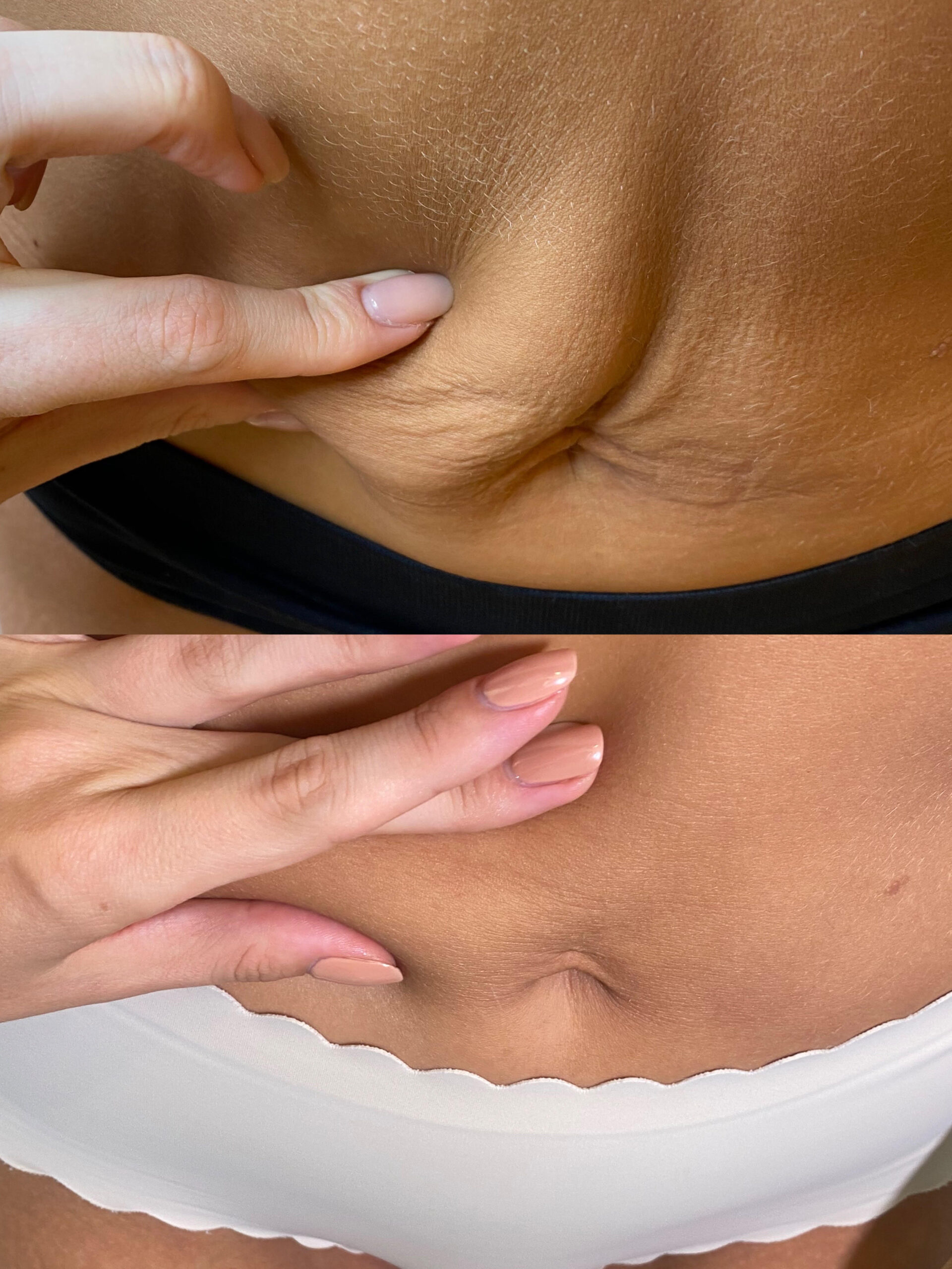Ujędrnianie skóry w BioSkin Ciechanów