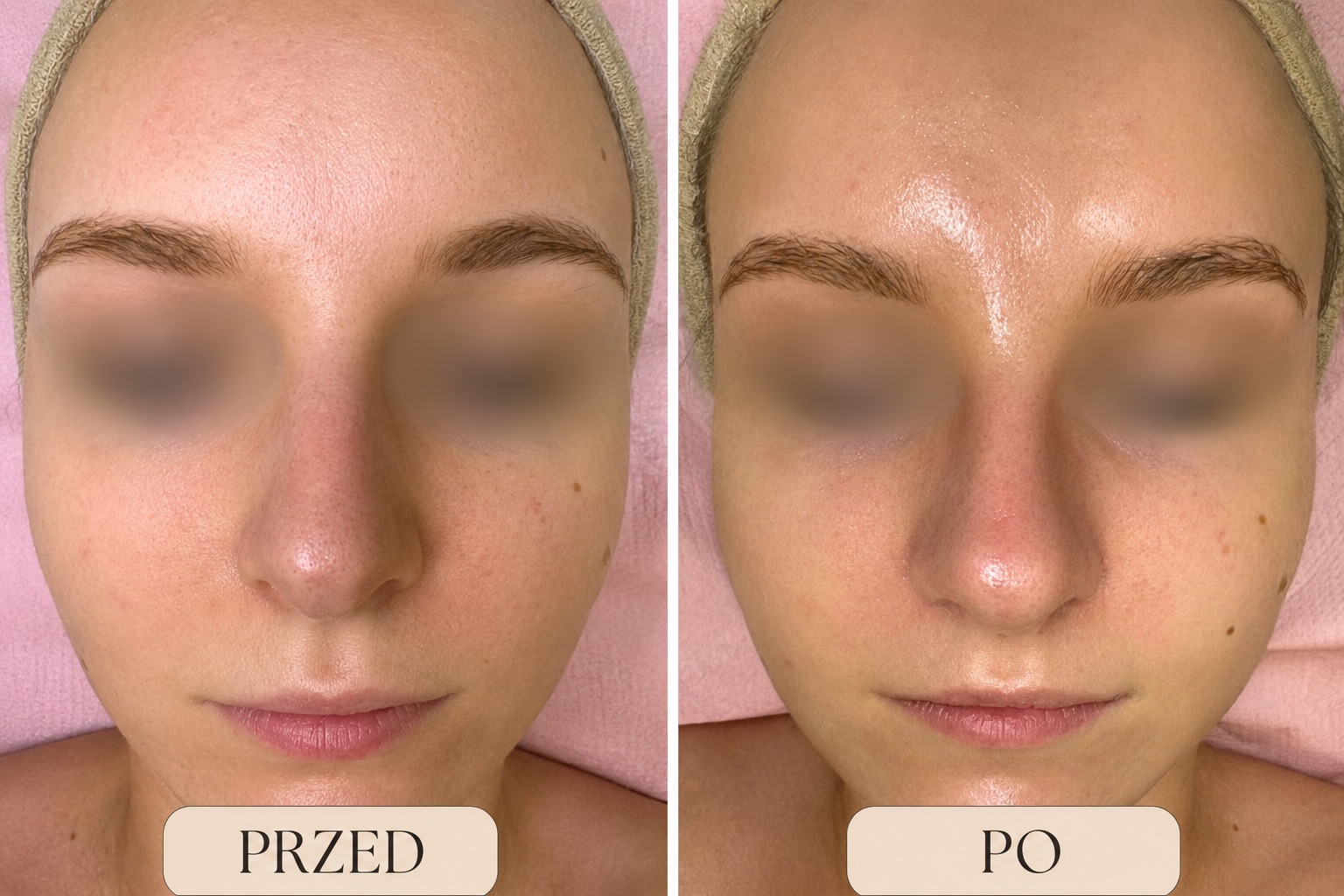 Efekt Endermolift w BioSkin Ciechanów
