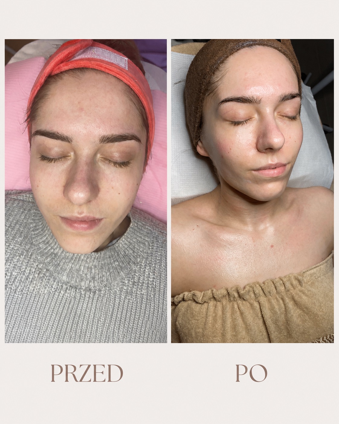 Efekt zabiegu Summer Shine, przed i po